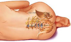 Psoas Compartment Block