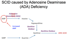 Purine salvage deficiencies: Adenosine deaminase deficiency