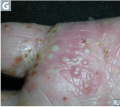 Pustular psoriasis