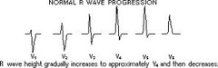 R wave progression