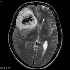 relatively rare, slow growing, usually frontal lobes, chicken-wire capillary pattern with 