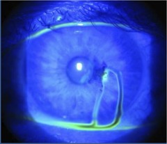Seidl's test (in this case it's positive), this represents a full thickness corneal perforation and warrants an immediate ophthalmology consult  Dr. J. Cross