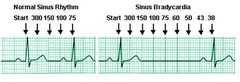 Simple HR determination