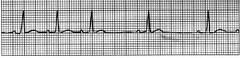 sinus arrhythmia