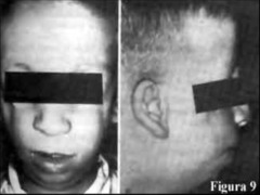 Syndrome characterized by underdeveloped cheek & jaw, down slanting eyes, & ear deformities