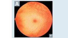 Tay-Sachs disease