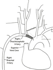 The carotids arise from the ________ ?