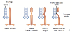 Tracheoesophageal Fistula