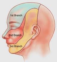 Trigeminal Neuralgia (tic dolereaux)  R or L side affected more?  Men or women more?