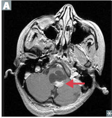 usually well circumscribed, most often in posterior fossa (in kids), may be supratentorial GFAP positive, benign, good prognosis Rosenthal fibers—eosinophilic, corkscrew fibers, cystic and solid; has a CYST with PROTRUDING NODULE