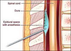 What are the symptoms of an epidural or spinal hematoma?