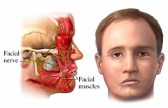 What causes facial paralysis?