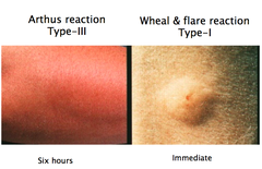 What is arthus rxn caused by?