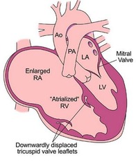 What is Ebstein's Anomaly?