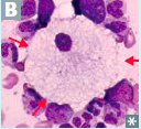 what is found on histology of NP disease?