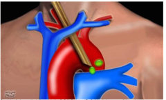 What is likely being compressed during a medistinoscopy and what side should you monitor SpO2 and BP?