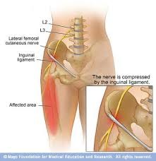 What is meralgia paresthetica?