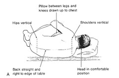 What is the most common approach for epidurals?