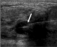 What should you do if a needle breaks while giving an injection?