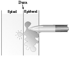 When dosing an epidural after a dural puncture, some local will leak thru the puncture site, what does this result in?