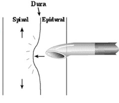 When dosing the epidural after spinal block, the epidural exerts a ____ ___ on the epidural space, this will push the spinal level _____ than expected for simple epidural dosing.