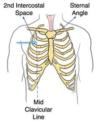 Where do you perform a needle thoracotomy?