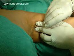 Which approach is optimal for procedures from the elbow to the hand?