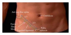 Which block does not require a nerve stimulator, is performed quickly, is not very stimulating and patients do not often require sedation?