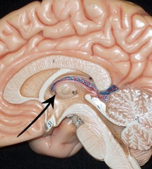 3rd ventricle