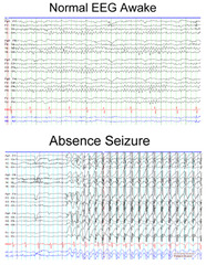 absence seizures EEG