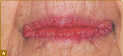 Acanthosis nigricans...  A. Verrucous and papillomatous growths of the vermillion border of the lip.   Fitzpatrick's Figure 153-2