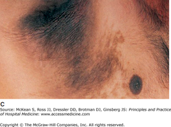 Acanthosis nigricans   Acanthosis nigricans: typical hyperpigmented, velvety, verrucous axillary plaques.   (Reproduced, with permission, from Wolff K, Johnson RA, Suurmond D. Fitzpatrick's Color Atlas & Synopsis of Clinical Dermatology. 6th ed. New York: McGraw-Hill; 2005. Fig. 5-1.)
