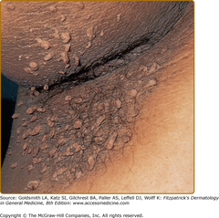 Acanthosis nigricans   The clinical hallmark of acanthosis nigricans is development of gray-brown, velvety plaques that may start as a dirty appearance.  Fitzpatrick's Figure 153