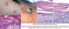 Actinic Keratosis (AK)