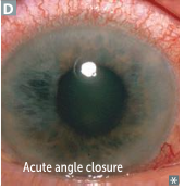 Acute Closed/Narrow Angle Closure