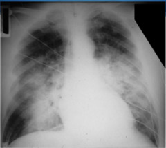 Acute Respiratory Distress Syndrome impaired gas exchange, inflammatory mediator release, hypoxemia