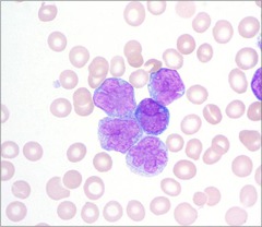 Adult T cell leukemia lymphoma (ATLL)