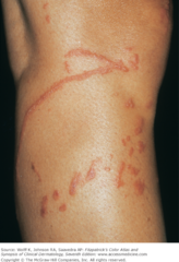 Allergic phytodermatitis of leg    (Marlin D&E Lecture PP12)