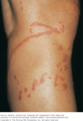 Allergic phytodermatitis of leg   Prevention of Irritant Dermatitis Removal of the irritant If exposed, wash with water or a neutralizing solution  (Marlin D&E Lecture PP12;16)