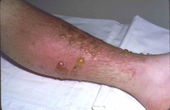 Allergic Phytodermatitis
