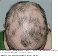 Alopecia areata  Topical/Systemic Steroids Minoxidil Anthralin Immunotherapy Photo(chemo)Therapy Cyclosporine  Fitzpatrick CH 88 FIGURE 88-11