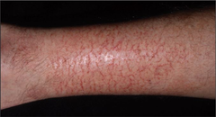 Asteatotic Dermatitis  Treatment- Avoid hot baths and showers with soap  Tepid baths with bath oils, skin lubrication  Corticosteroid ointments if lesions inflamed.  (Marlin D&E Lecture PP60-63)