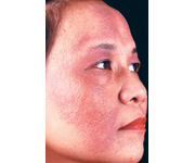 Atopic Dermatitis  Facial features- erythema, perioral pallor, Dennie-Morgan lines, allergic shiners   (Marlin D&E Lecture PP19;27)