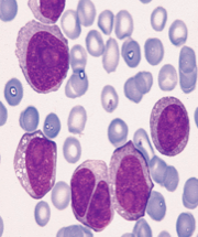 B prolymphocytic leukemia or B-PLL