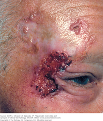 Basal cell carcinoma (BCC)  There are 5 clinical types: nodular, pigmented, ulcerating, sclerosing (cicatricial), and superficial.  Fitzpatrick Figure 11-21 (I remember it as: Nodular P.U.S.S)