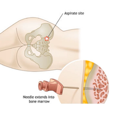 BM aspirate site