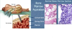 Bone Marrow Aspiration/Biopsy