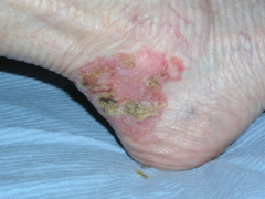 Bowen's disease