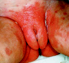 Candida Diaper Dermatitis   Bates Pg 879