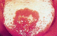 Candidiasis.   Note the thick white coating from Candida infection. The raw red surface is where the coat was scraped off.  Infection may also occur without the white coating.   Bates pg 289